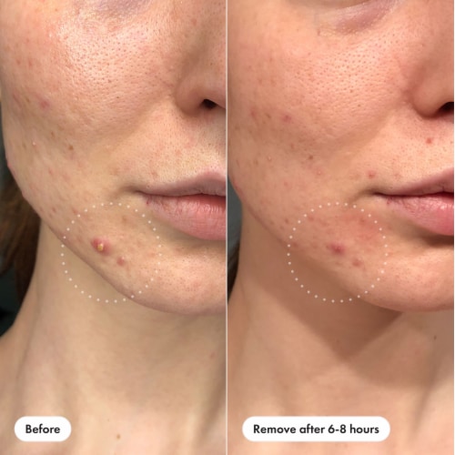 Hero Cosmetics Mighty Patch Invisible+ Acne Pimple Patches - Hero Cosmetics Mighty Patch Invisible+ Acne Pimple Patches